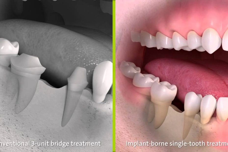 Dental Bridge Costs, Types And More (Uk Tooth Bridge Guide)