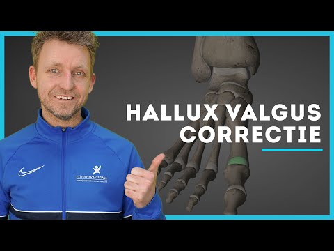 Hallux Valgus correctie - Pijn aan je grote teen?